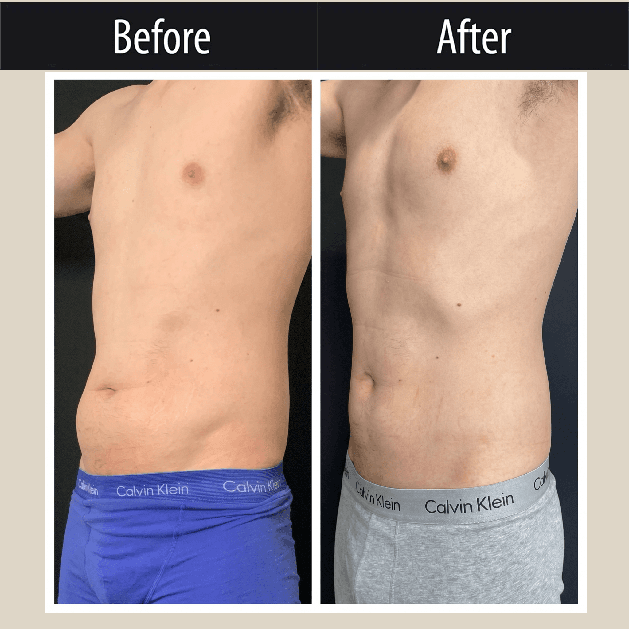 CoolSculpting Elite, before and after, view 4