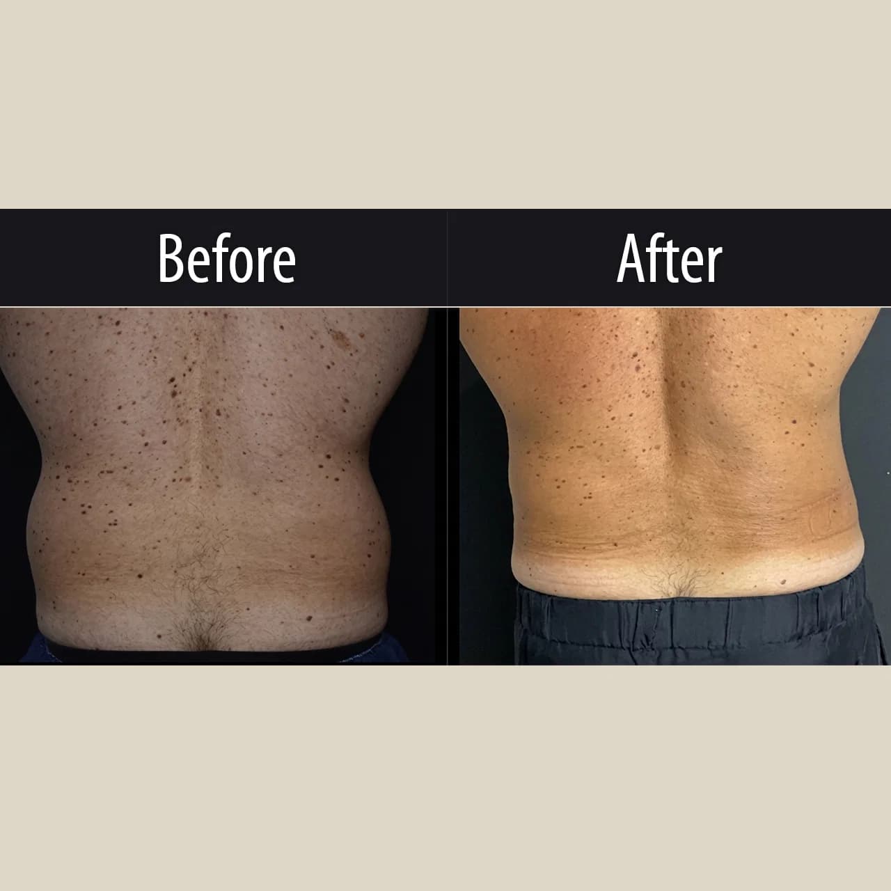 CoolSculpting Elite, before and after, view 1