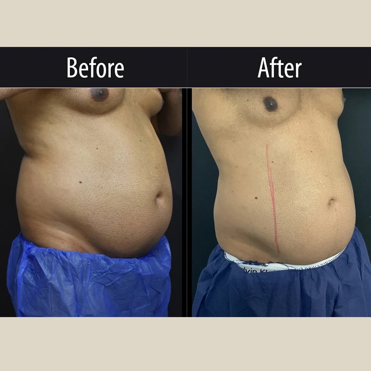CoolSculpting Elite, before and after, view 2