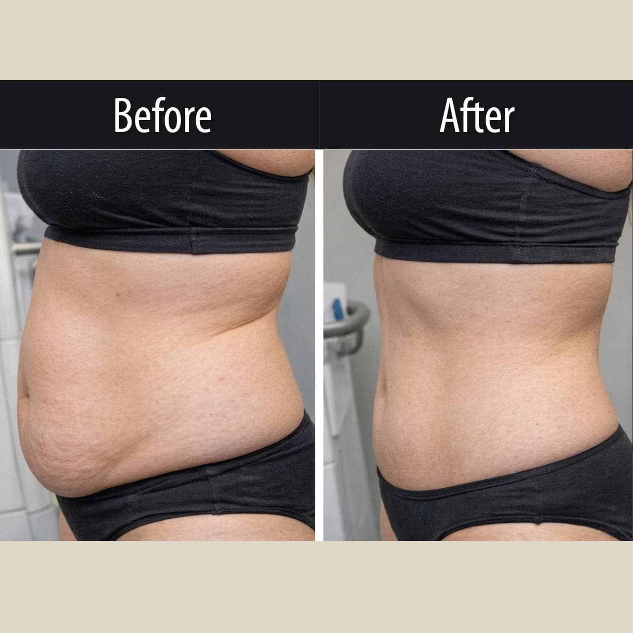 CoolSculpting Elite, before and after, view 3