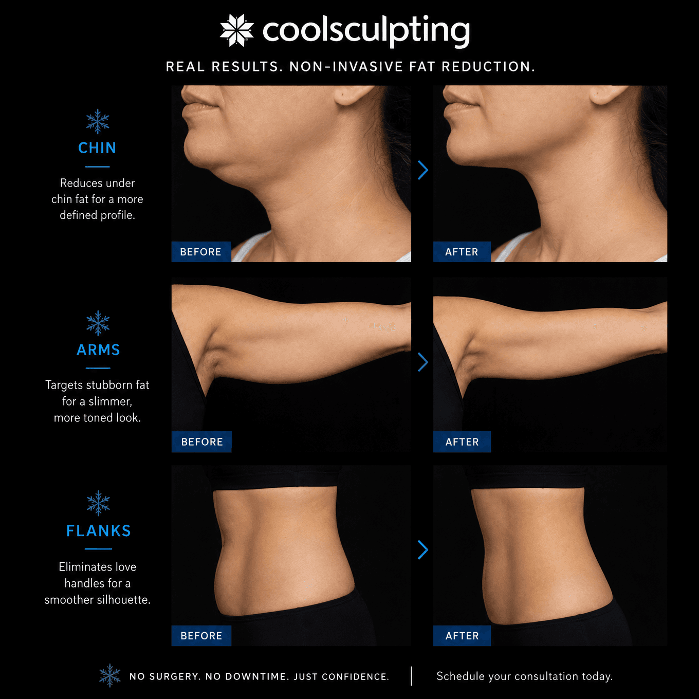 CoolSculpting Elite before and after: chin, arms and flanks